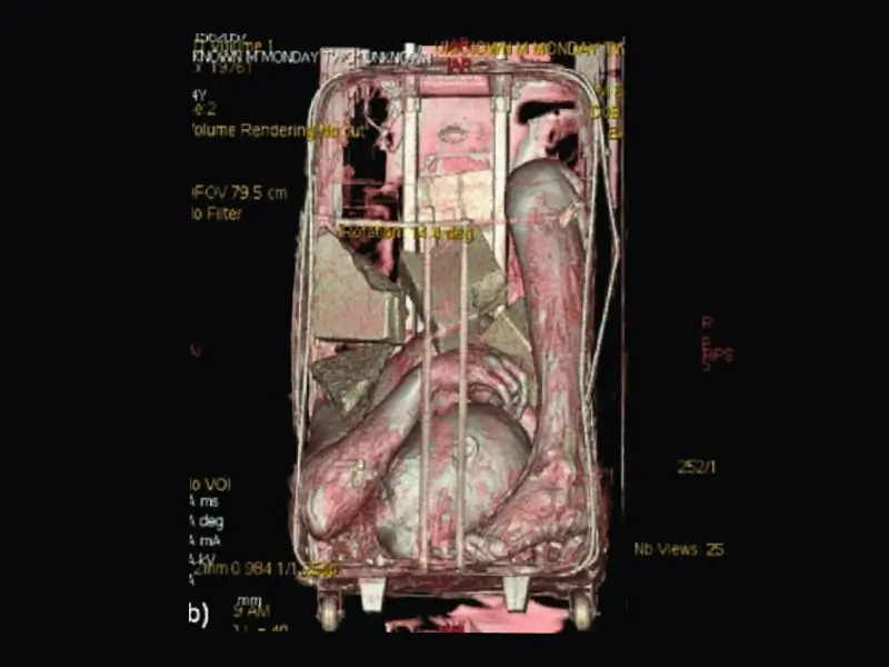 How CT Scans Solved a Suitcase Murder Case
