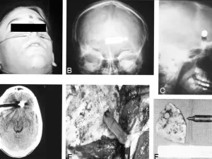 Man Survives Crossbow Bolt Lodged in Forehead for Days